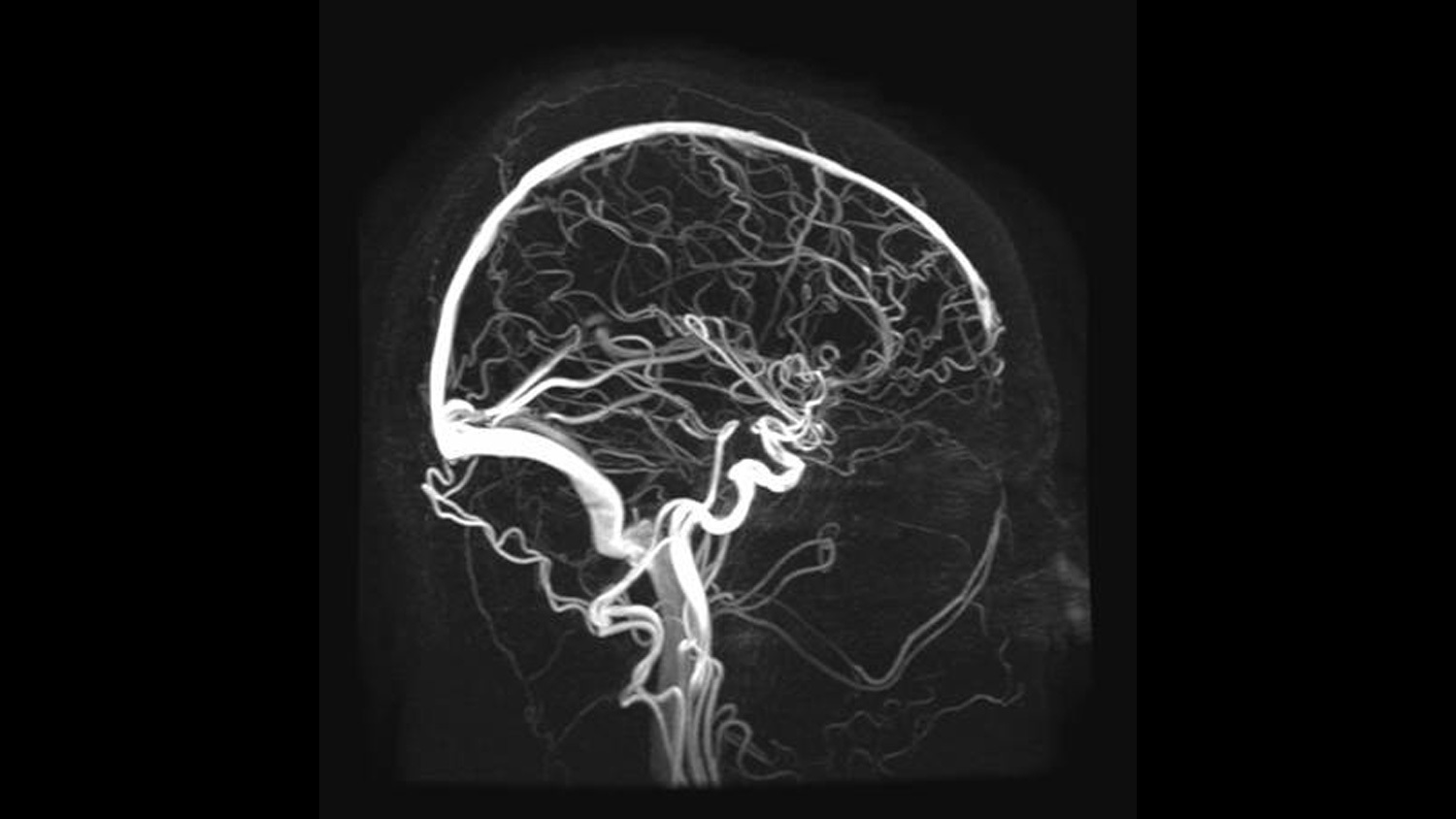 Кт сосудов головы и шеи. Магнитно-резонансная ангиография сосудов головного мозга. МРА (магнитно-резонансная ангиография). Мрт венография сосудов головного мозга. Мрт ангиограмма сосудов головного мозга.